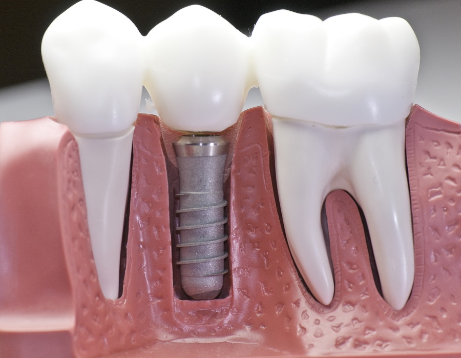 IF YOU HAVE DENTAL IMPLANTS, YOU MAY NEED TO KEEP AN EYE OUT FOR PERI-IMPLANTITIS