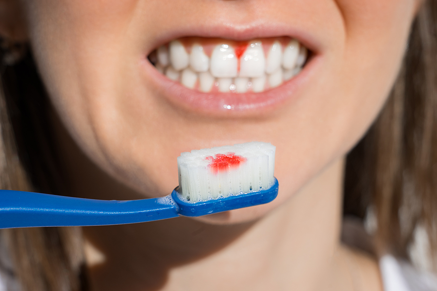 WHY DO MY GUMS BLEED REGULARLY?