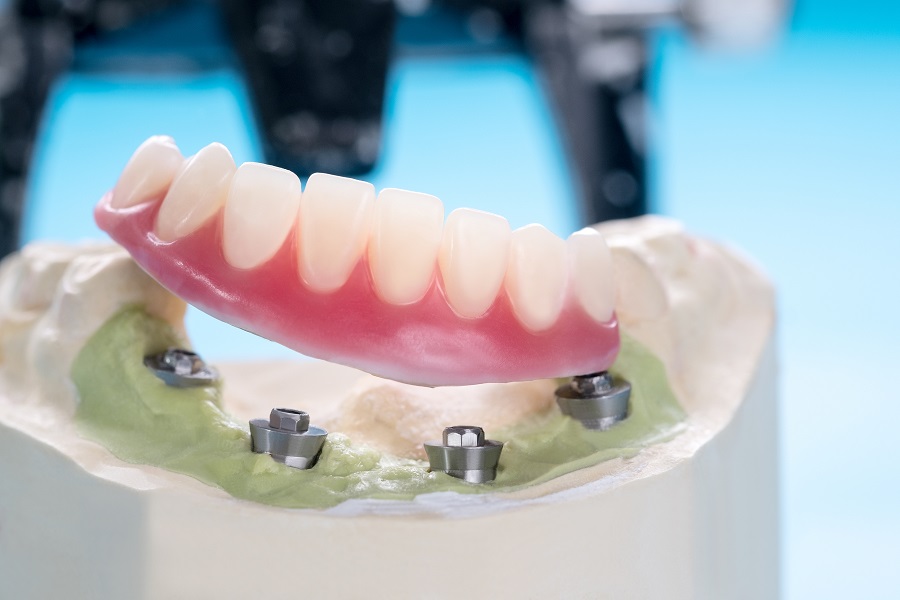 DO YOU KNOW ABOUT ALL-ON-4 IMPLANTS?