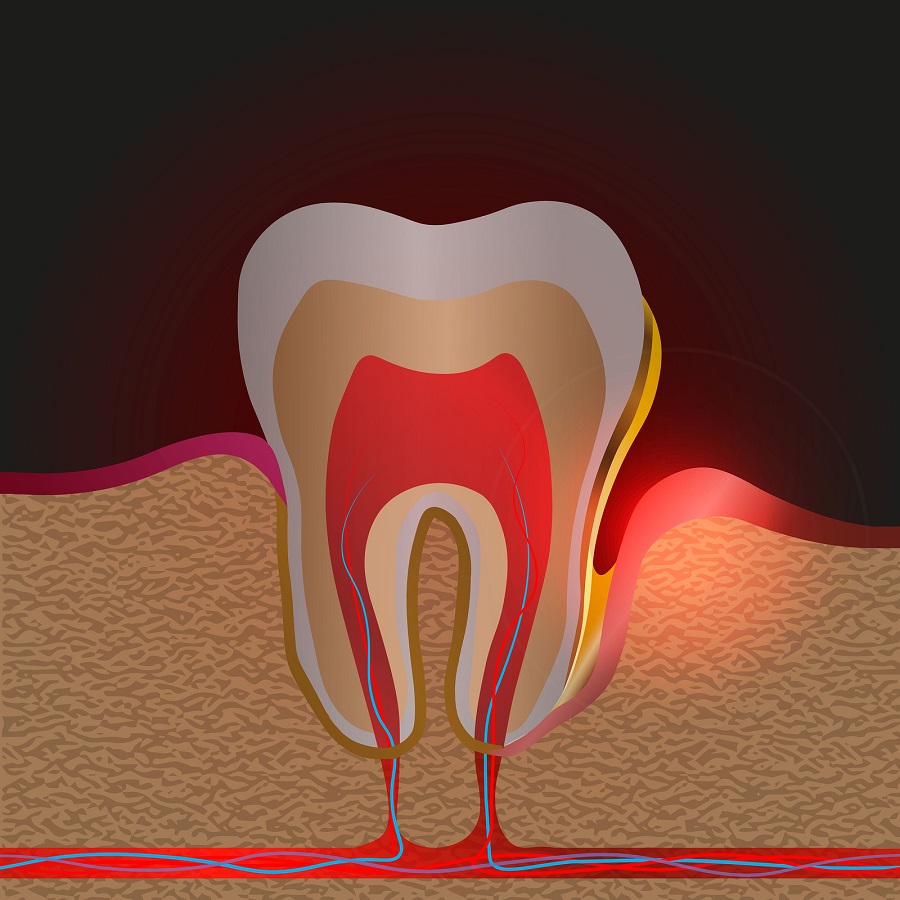 WHAT ARE THE SIGNS OF PERIODONTAL DISEASE THAT YOU SHOULD BE LOOKING FOR IN YOUR MOUTH?