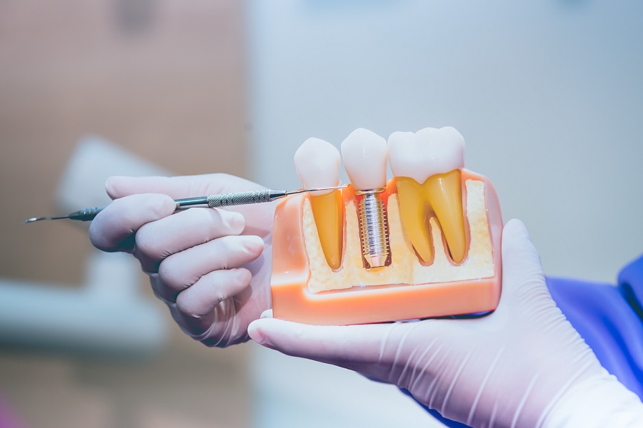 CONSIDERING DENTAL IMPLANTS?