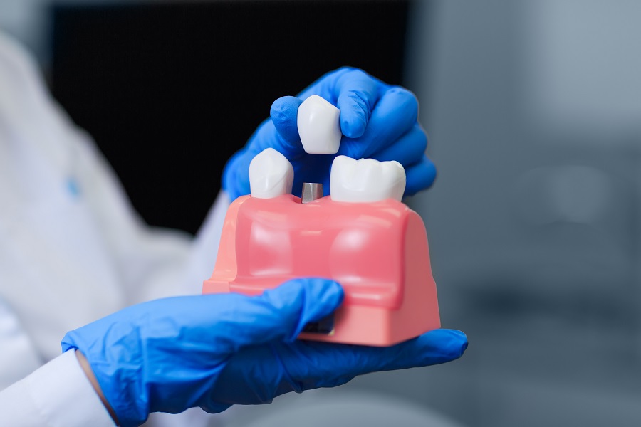 DENTAL IMPLANT PLACEMENT BASICS AS A STEP-BY-STEP PROCESS
