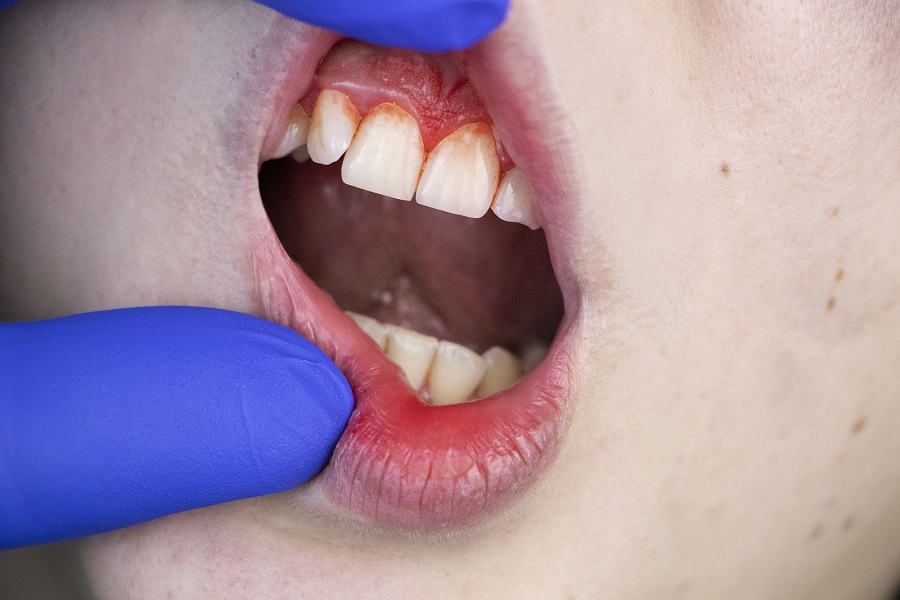 SIX REASONS WHY YOU SHOULD SEE A PERIODONTIST TO EXAMINE YOUR GUMS!