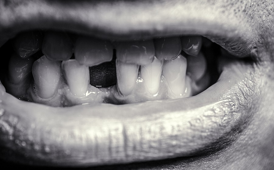 A TOOTH THAT IS LOST TO SEVERE DECAY CAN OFTEN BE REPLACED WITH A DENTAL IMPLANT