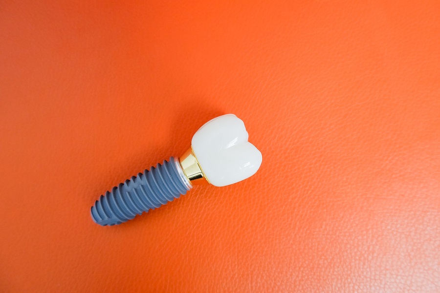 CONSIDERING DENTAL IMPLANTS? A SINUS LIFT CAN HELP!