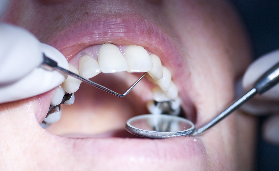 AVOIDING GUM DISEASE